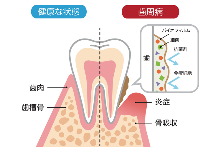 歯並びが悪いと・・・虫歯や歯周病になりやすい