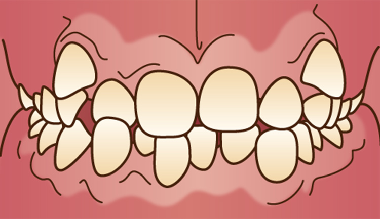 叢生（八重歯、乱杭歯）