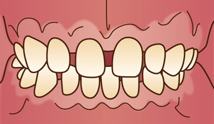 空隙歯列（すきっ歯）