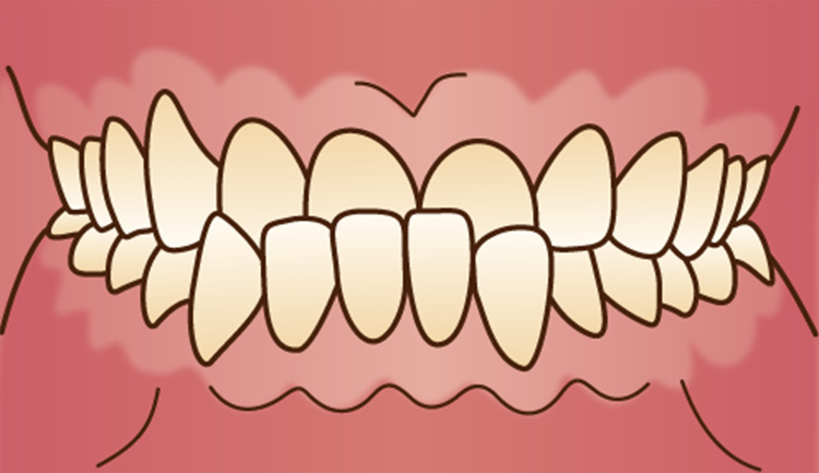 反対咬合（受け口、下顎前突）