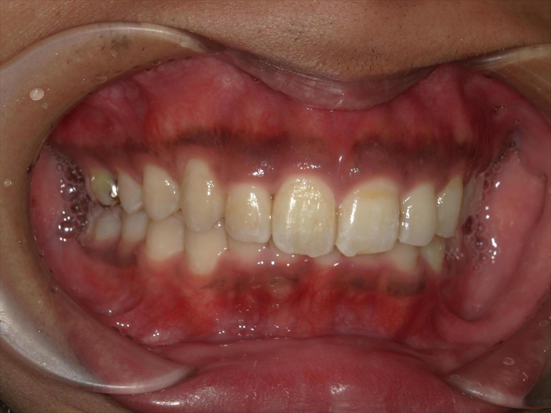 After image