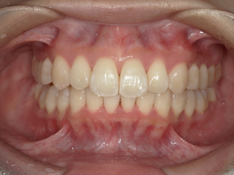 After image