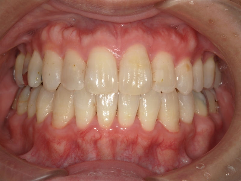 After image
